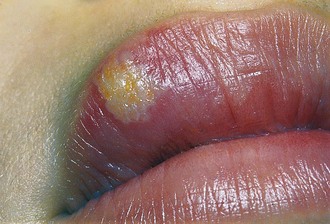 Cold lips sore yellow on crust