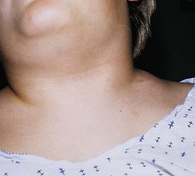 children swollen supraclavicular lymph node
