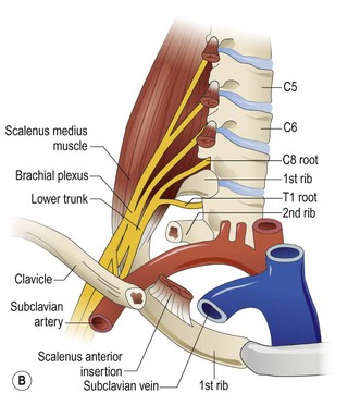 Thoracic outlet syndrome | Obgyn Key