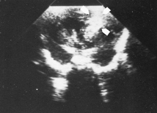 Intraventricular Hemorrhage Premature Babies