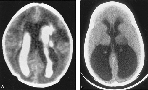 Intraventricular Hemorrhage of the Preterm Infant Obgyn Key