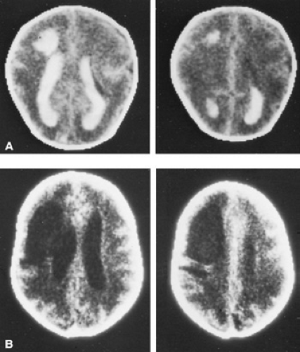 Intraventricular Hemorrhage Of The Preterm Infant | Obgyn Key