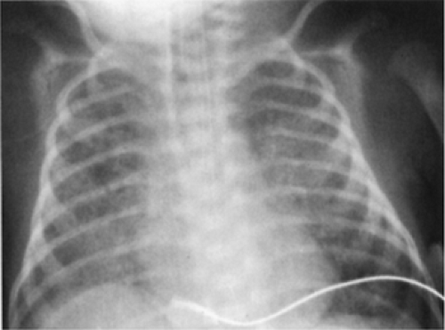 Bronchopulmonary Dysplasia Obgyn Key