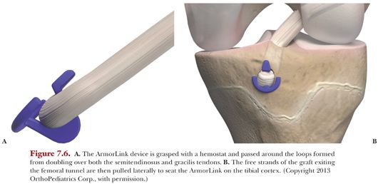 Technique: Anderson Technique | Obgyn Key