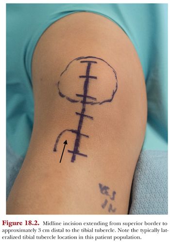 Medial Patellar Tendon Transfer with Proximal Realignment | Obgyn Key