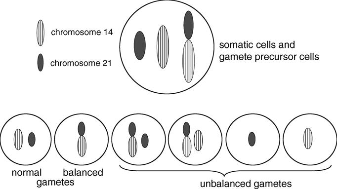 robertsonian translocation karyotype