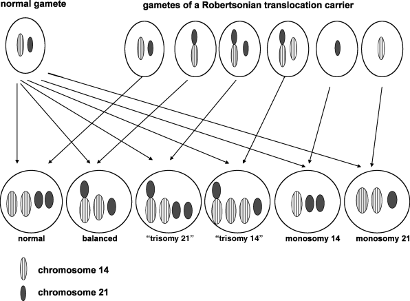 robertsonian translocation karyotype