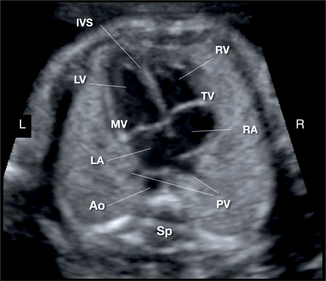 Cardiac Chambers: The Four-Chamber and Short-Axis Views | Obgyn Key