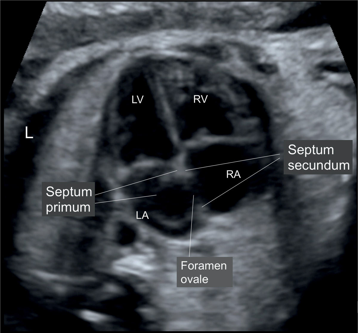 Cardiac Chambers: The Four-Chamber and Short-Axis Views | Obgyn Key