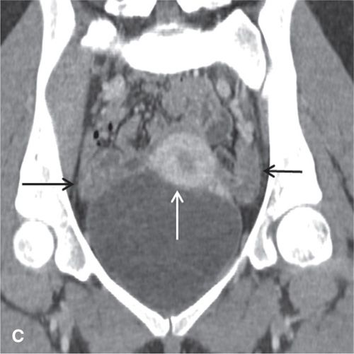 Ovaries Anatomy