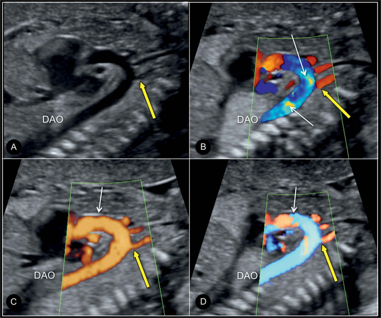 Fetal Aorta Ultrasound