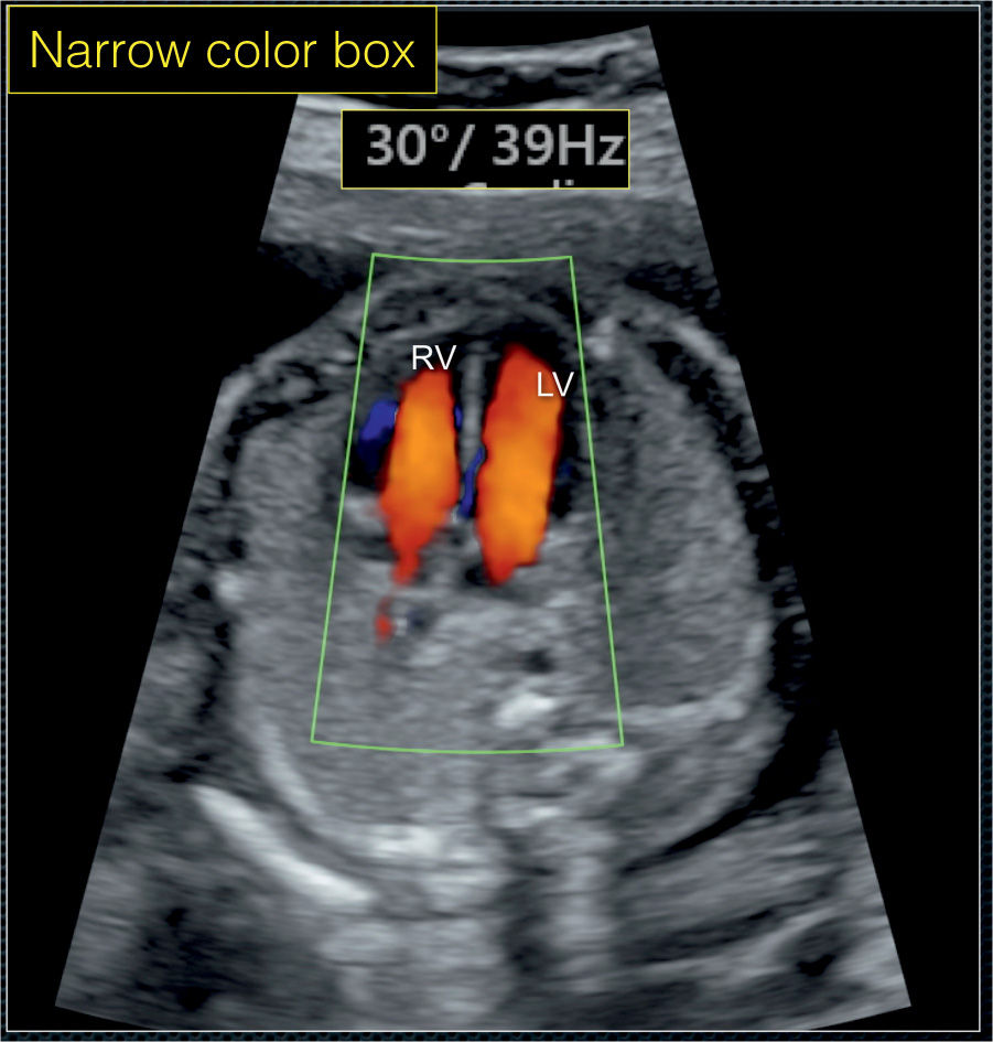 heart doppler ultrasound