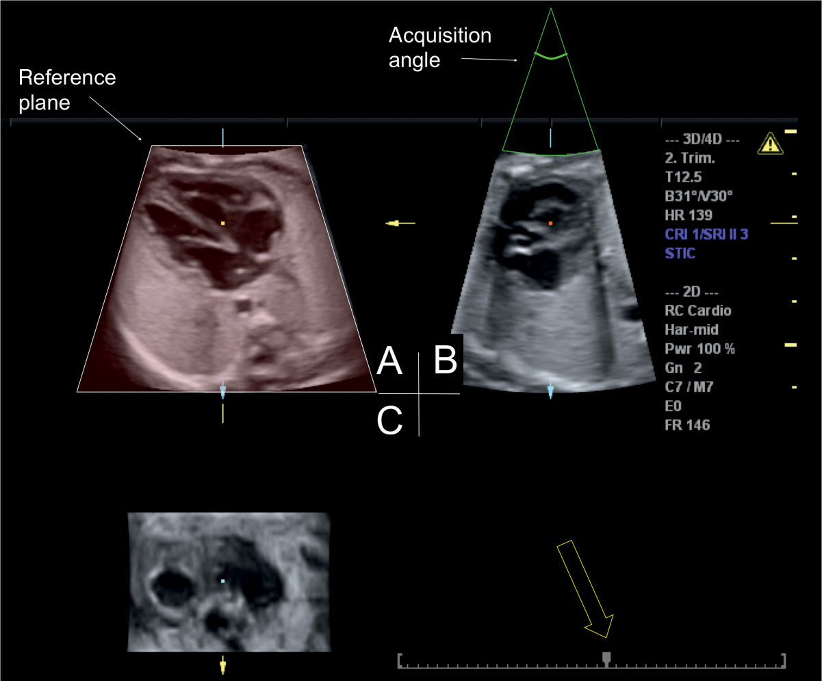 Fetal Heart Position Ultrasound