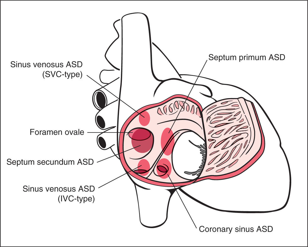 Atrial Ventricular And Atrioventricular Septal Defects Obgyn Key