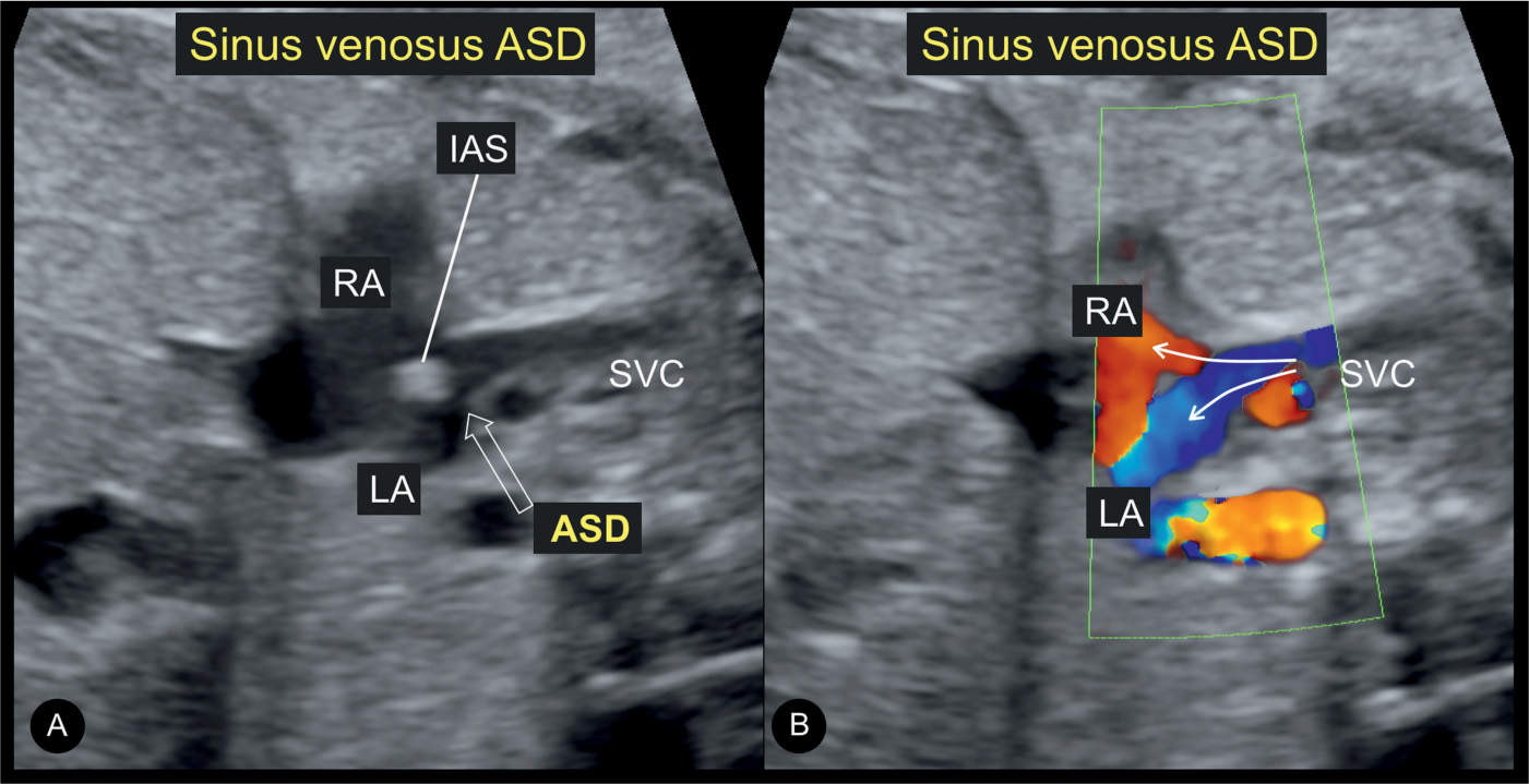 Atrial, Ventricular, and Atrioventricular Septal Defects ...
 Sinus Venosus Asd
