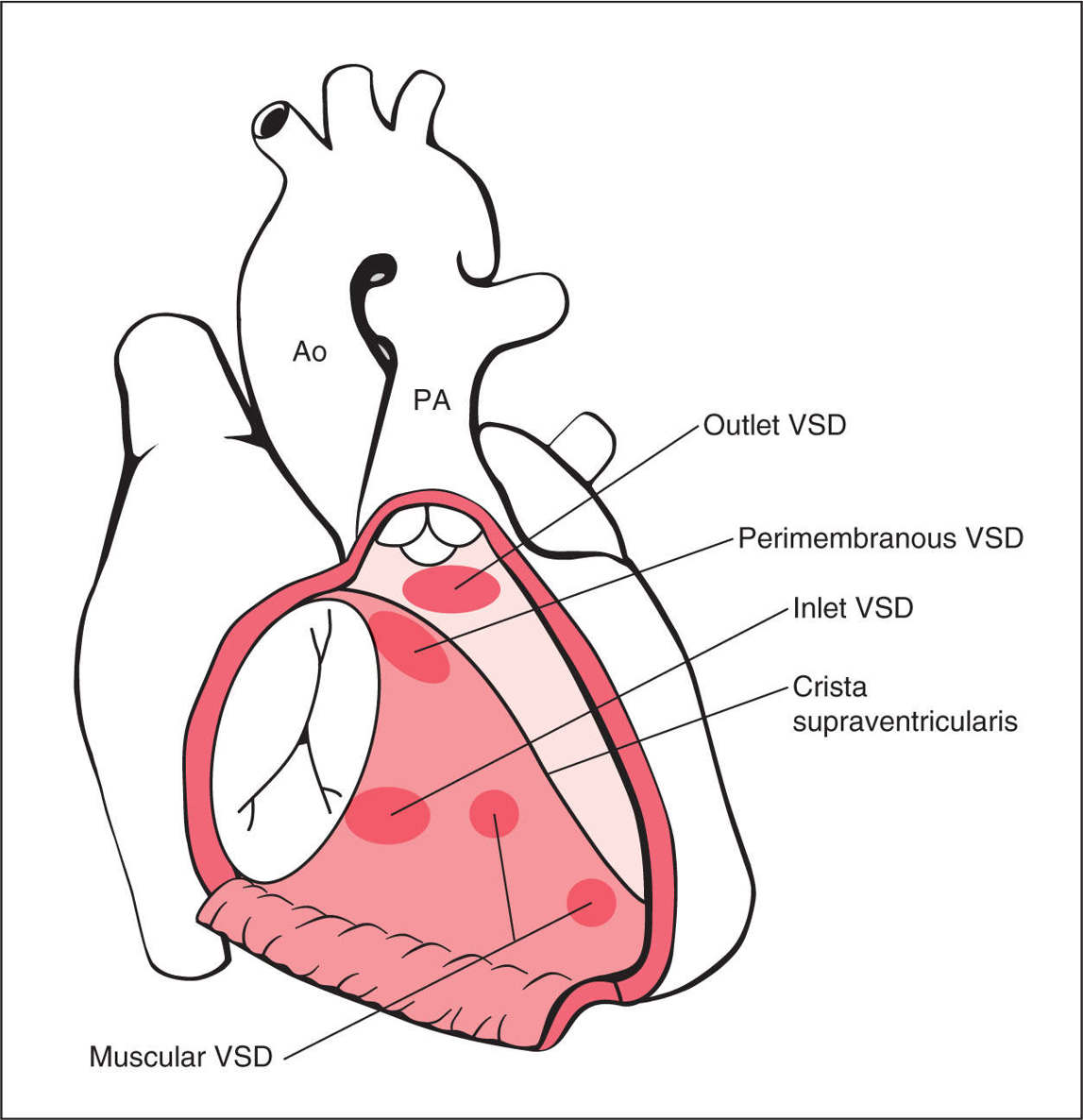 Atrial Ventricular And Atrioventricular Septal Defects Obgyn Key 5399