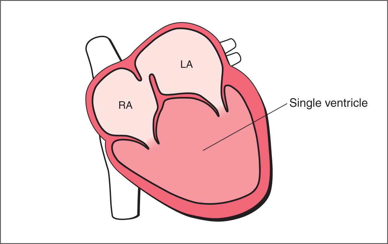 Univentricular Atrioventricular Connection, Double Inlet Ventricle, and  Tricuspid Atresia with Ventricular Septal Defect | Obgyn Key