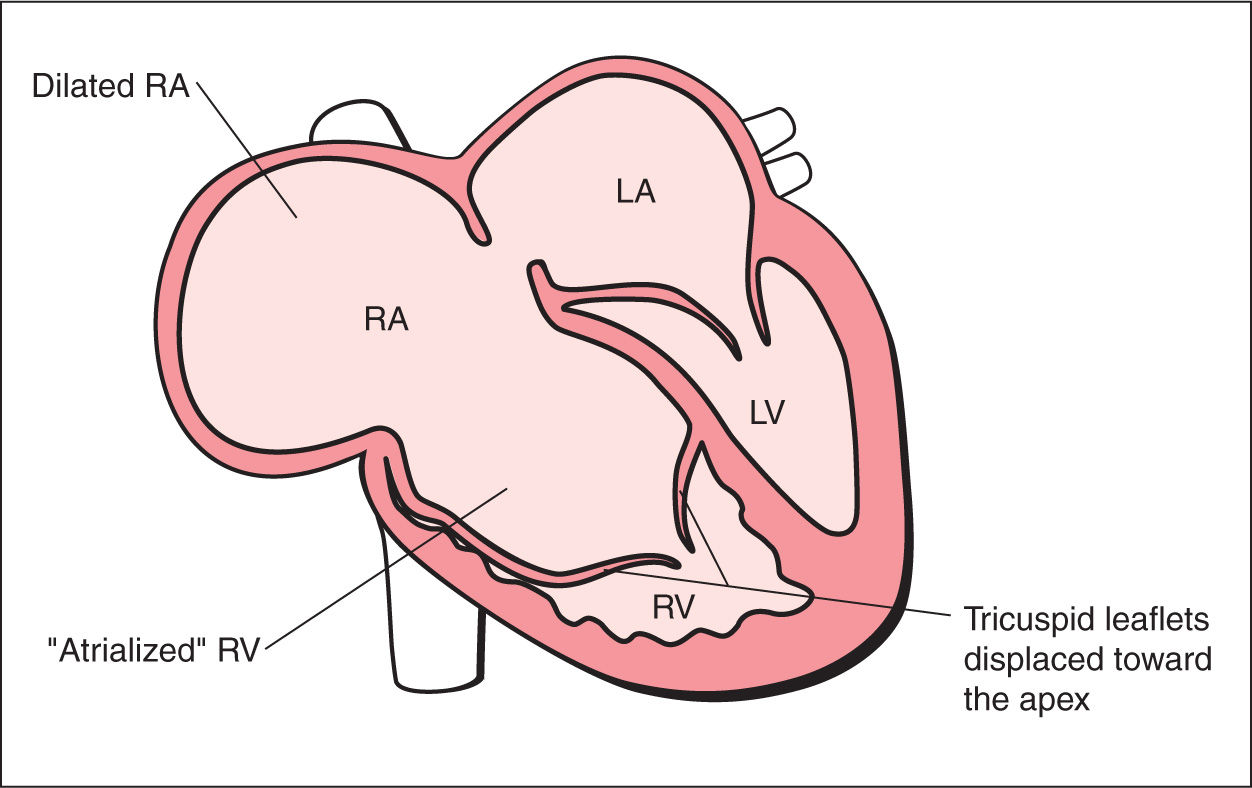 tricuspid valve leaflets