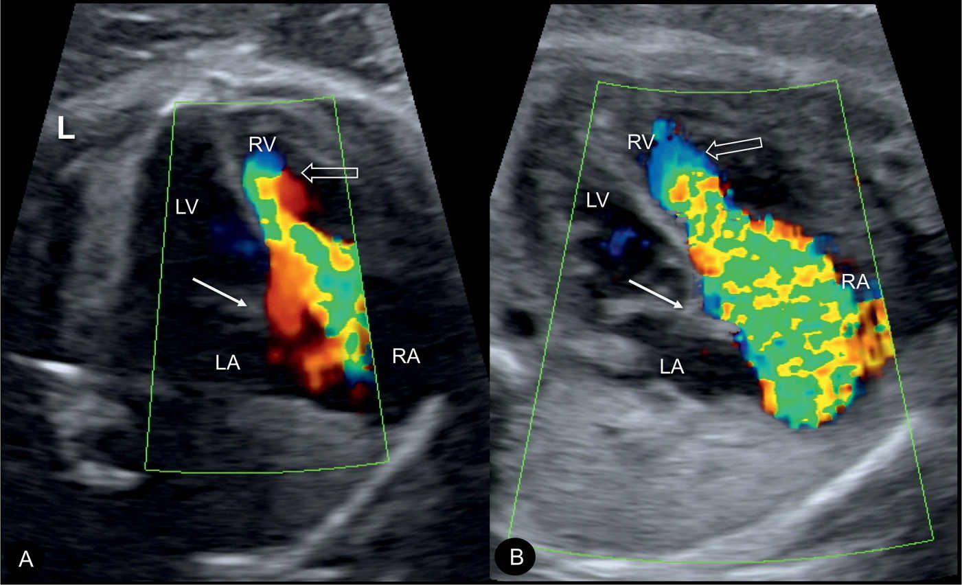 Ebstein Anomaly, Tricuspid Valve Dysplasia, and Tricuspid Regurgitation ...