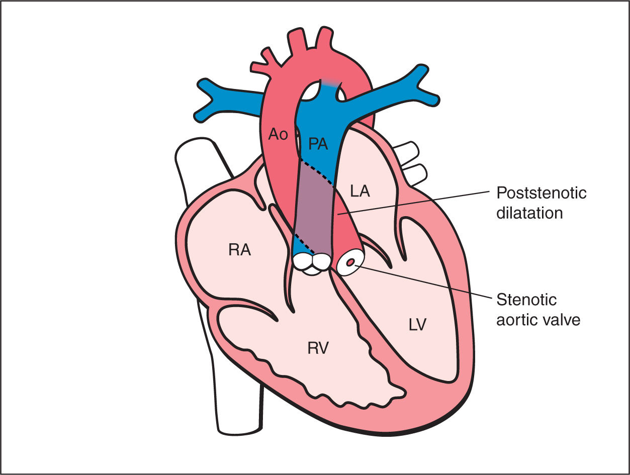 aortic-stenosis-and-bicuspid-aortic-valve-obgyn-key