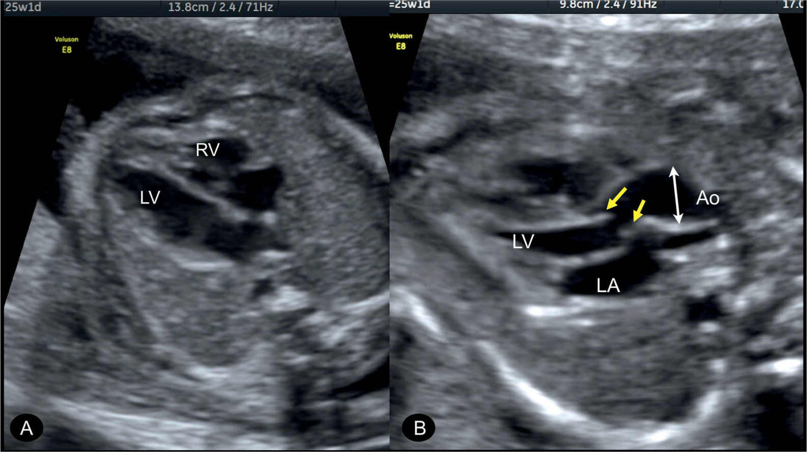 Aortic Valve Fetal Ultrasound | My XXX Hot Girl