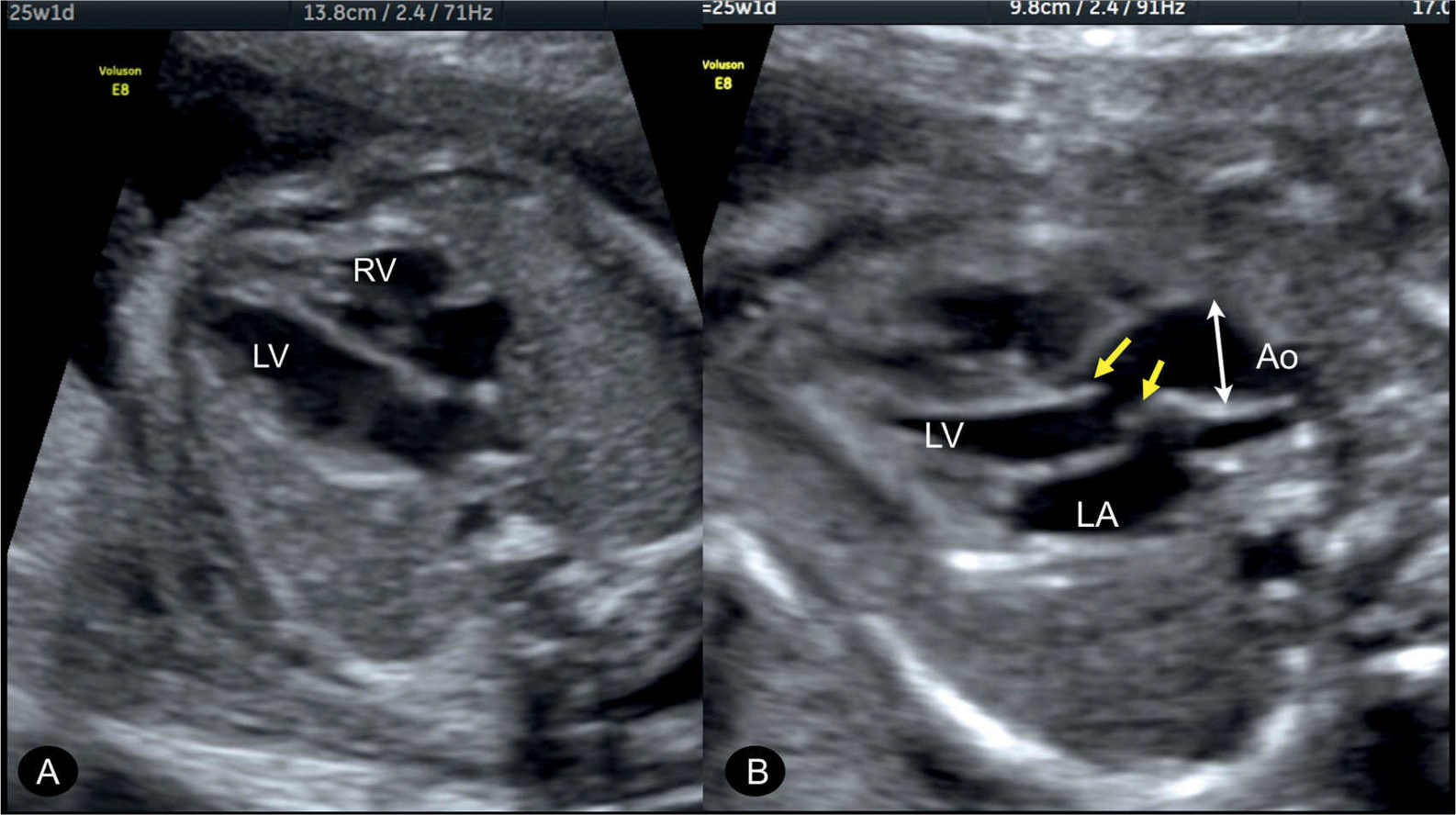 dilated aortic arch