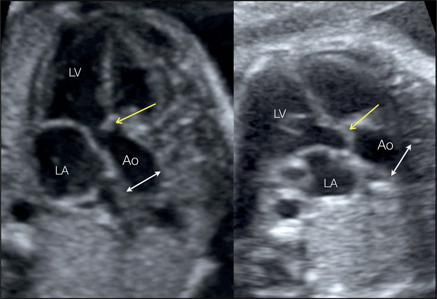 Dilated aortic arch - animationbery