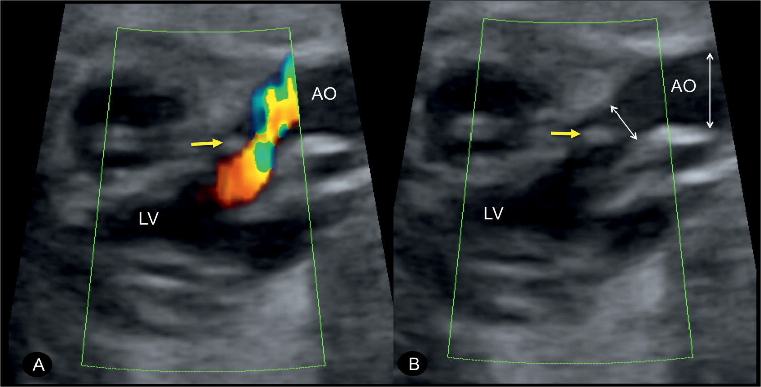Aortic Valve Fetal Ultrasound