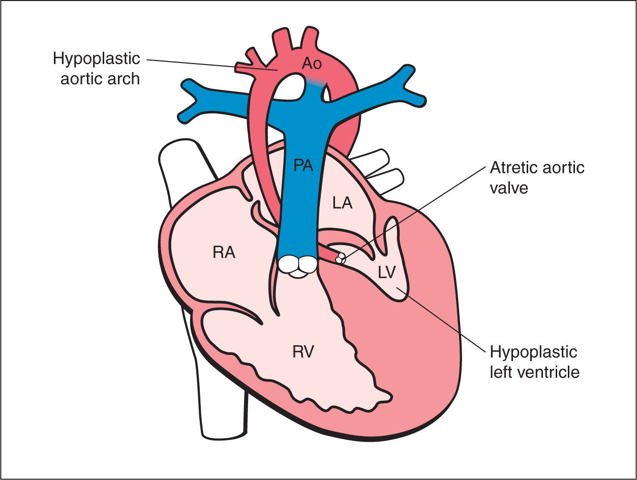 dilated aortic arch