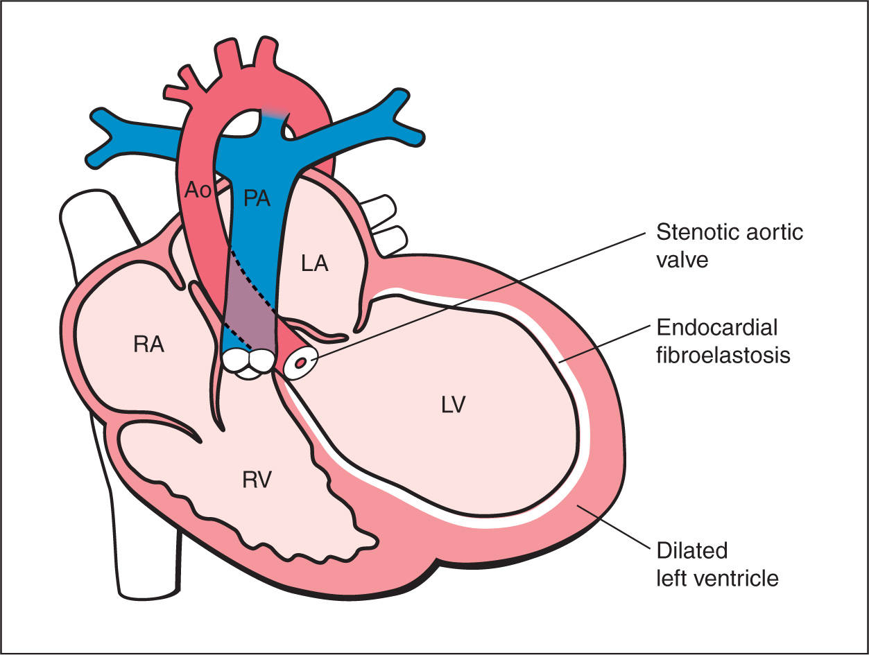 hypoplastic-left-heart-syndrome-and-critical-aortic-stenosis-obgyn-key