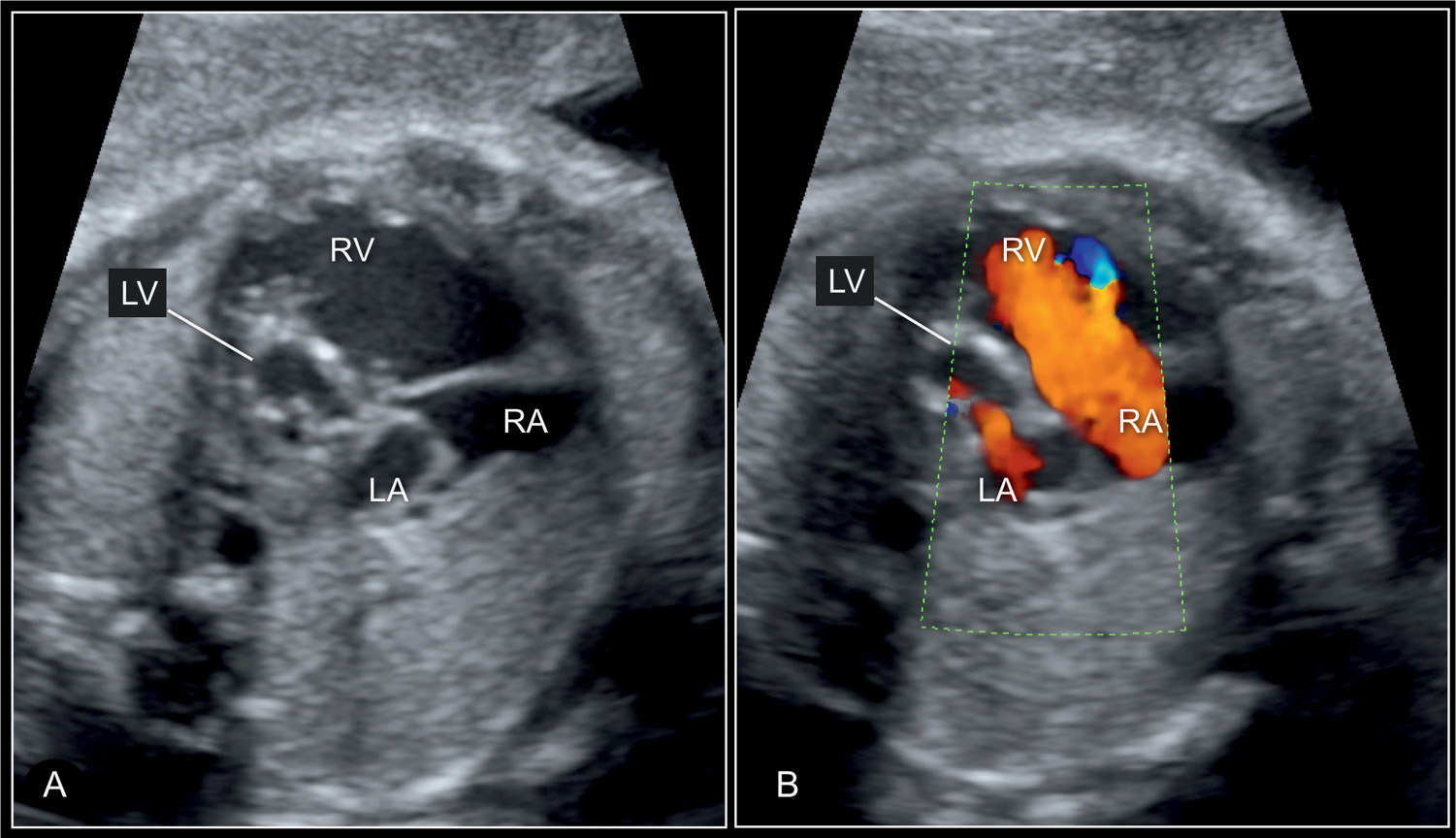 Echocardiography Aortic Stenosis