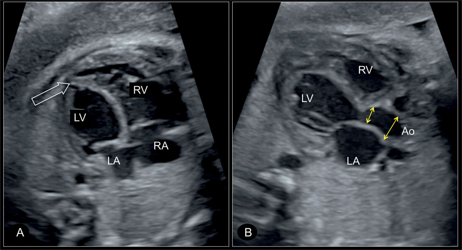 interrupted aortic arch syndrome