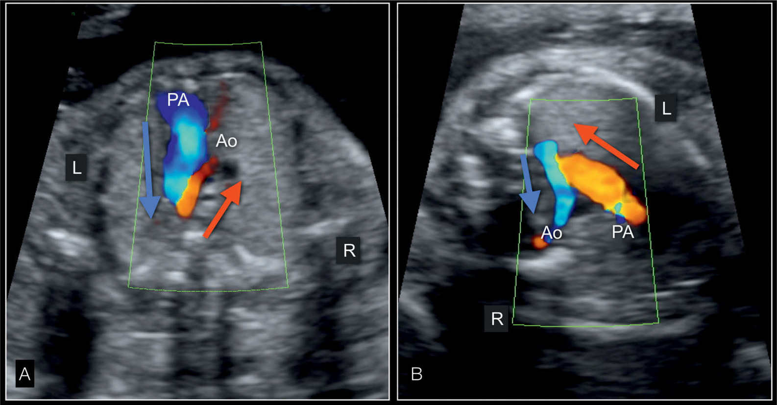 Hypoplastic Left Heart Syndrome And Critical Aortic Stenosis Obgyn Key 6376