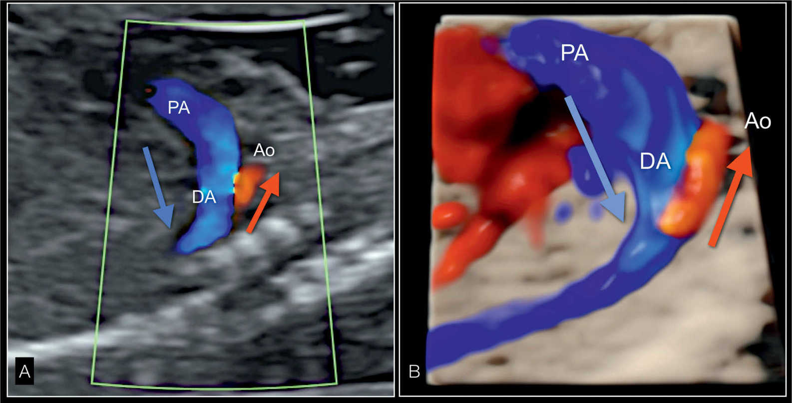 Hypoplastic Left Heart Syndrome and Critical Aortic Stenosis | Obgyn Key