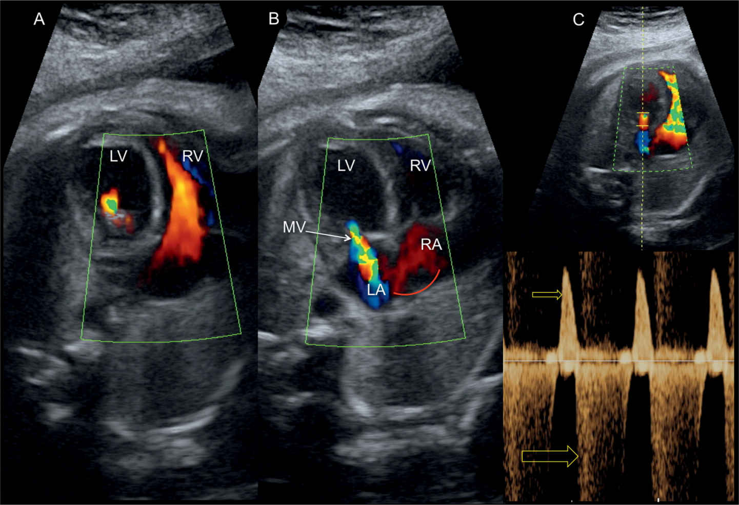 Aortic Valve Fetal Ultrasound