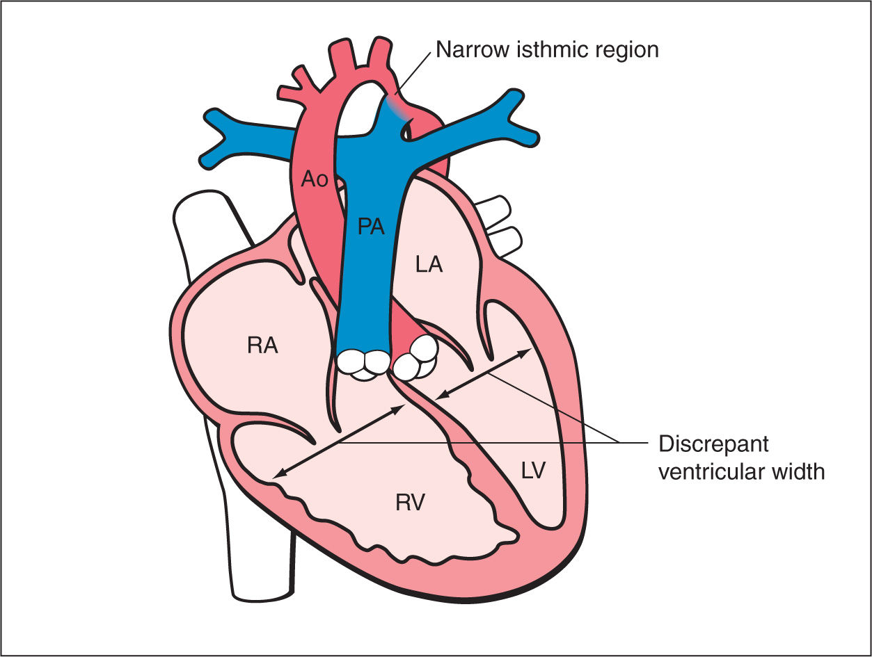 Coarctation of the Aorta and Interrupted Aortic Arch | Obgyn Key