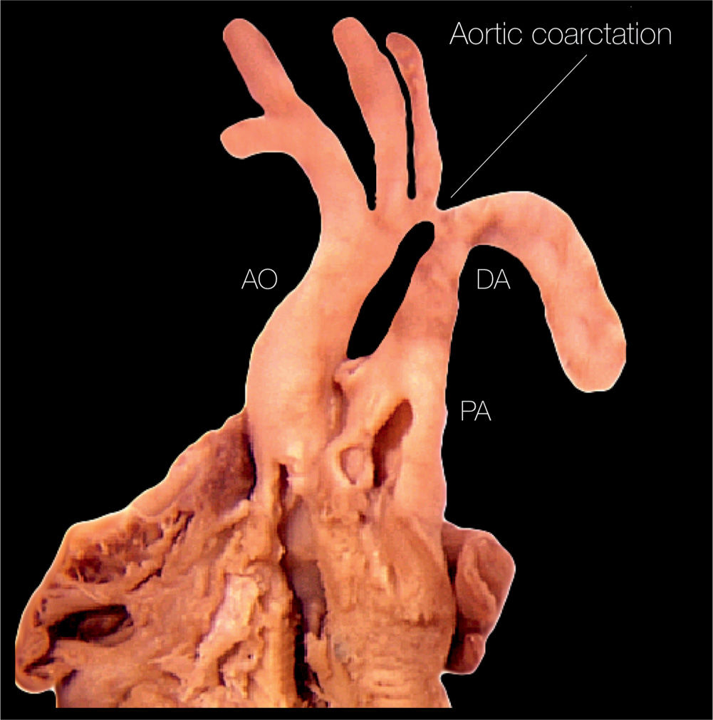 interrupted aortic arch neural crest