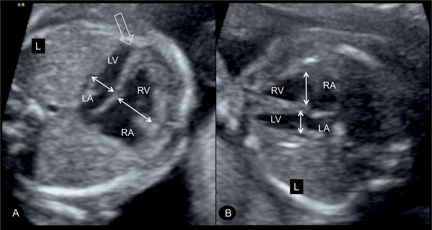 interrupted aortic arch in newborn