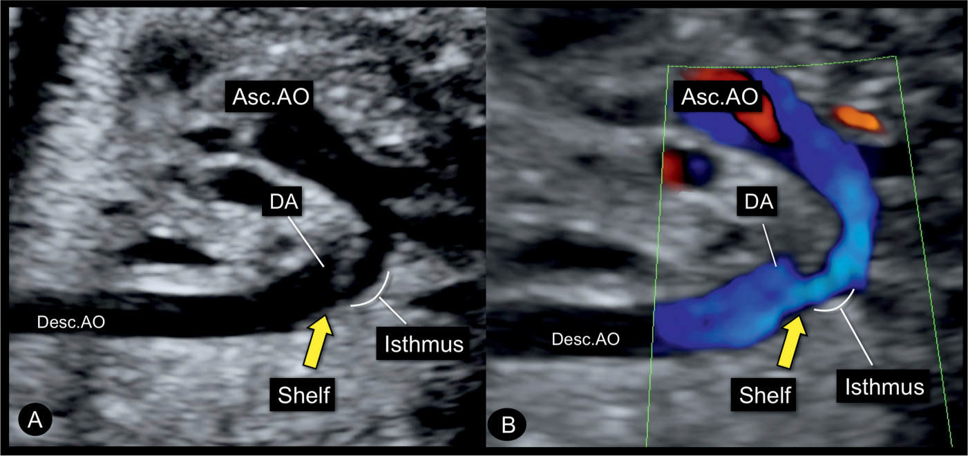 Right Aortic Arch Ultrasound