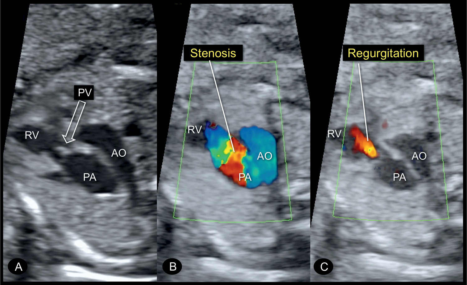 Portrait Details about   Pvs Doesnt Come W/manual Pulmonary Valve Stenosis Don't With Sticker 