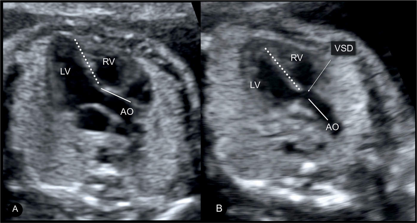 Ventricular Septal Defect Ultrasound