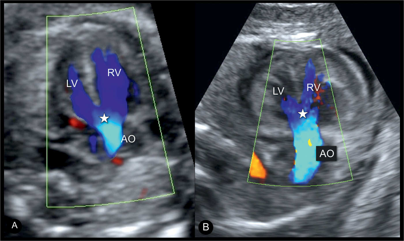 Overriding Aorta Fetal Ultrasound