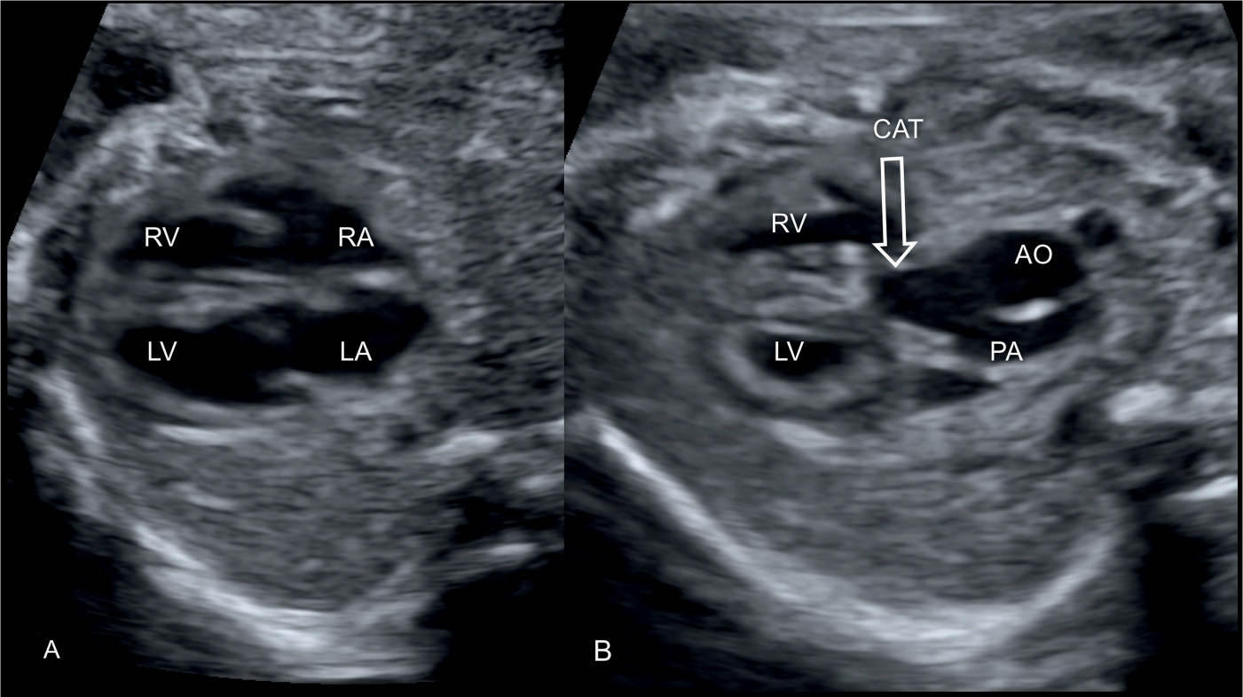 Truncus Arteriosus Fetal Ultrasound