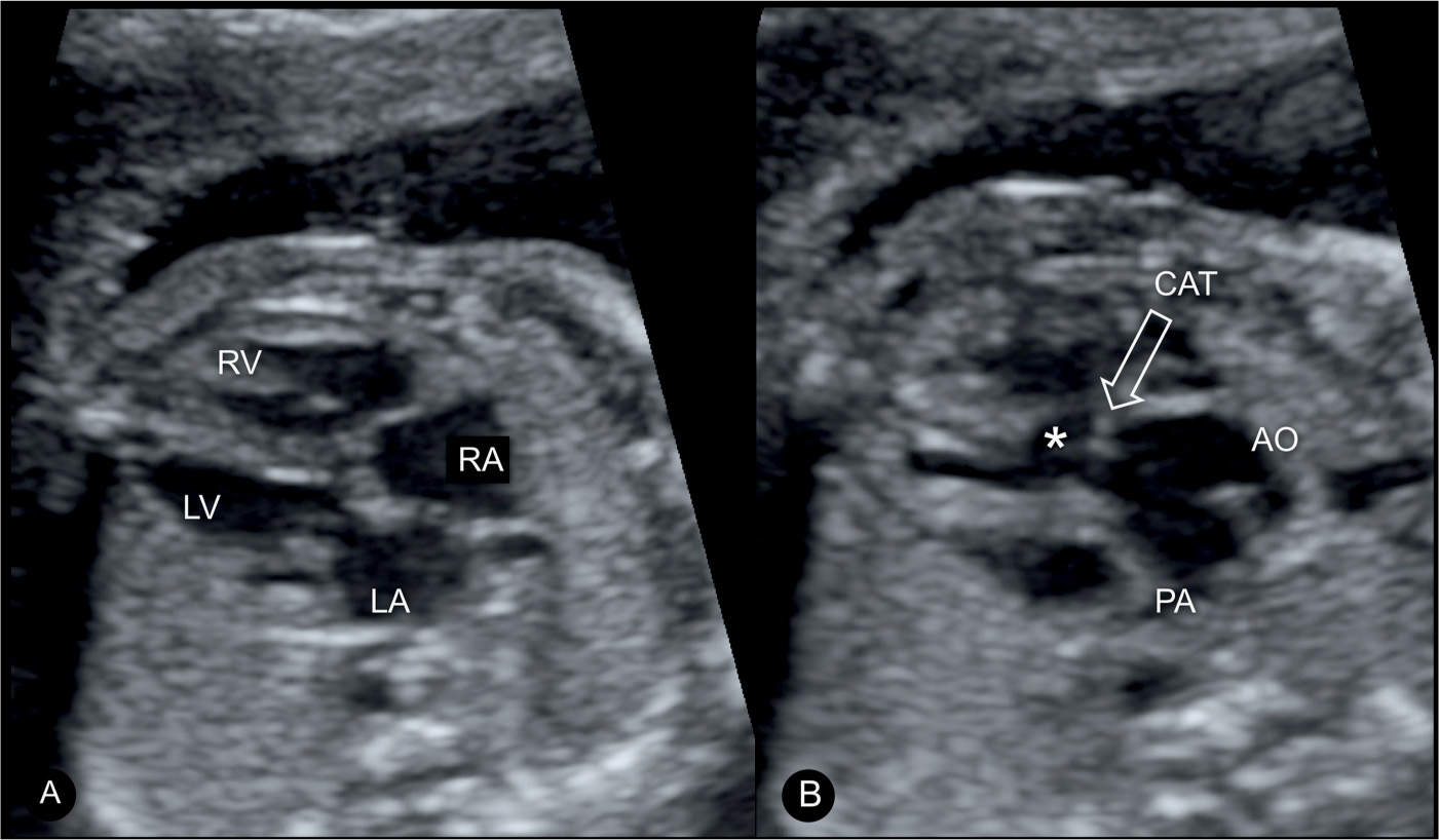 Truncus Arteriosus Fetal Ultrasound