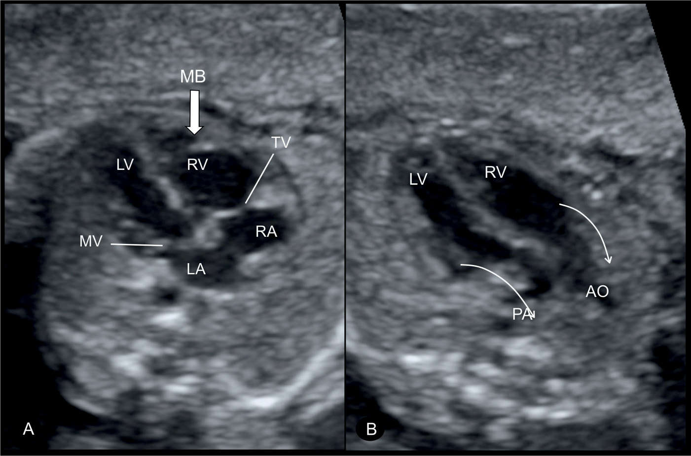 Transposition Of Great Vessels Fetal Ultrasound