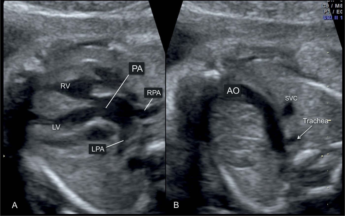 Transposition Of Great Arteries Fetal Ultrasound