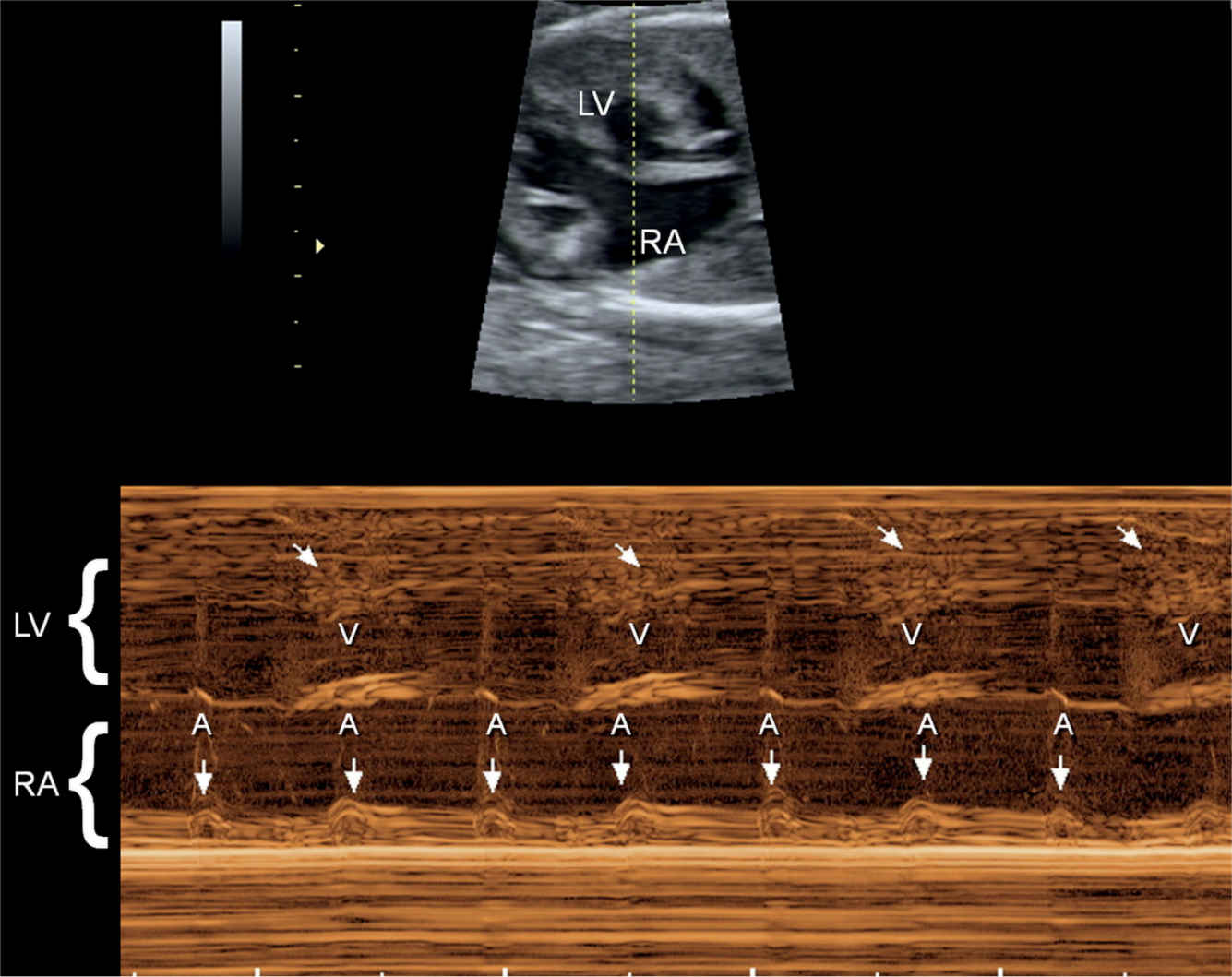 Second-degree atrioventricular block (fetal echocardiography
