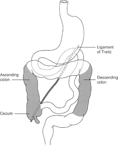 Ligament Of Treitz Malrotation