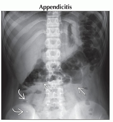 Small Bowel Obstruction | Obgyn Key