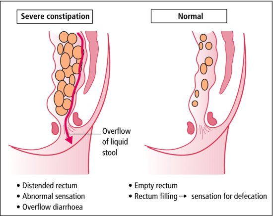 Faecal impaction with overflow